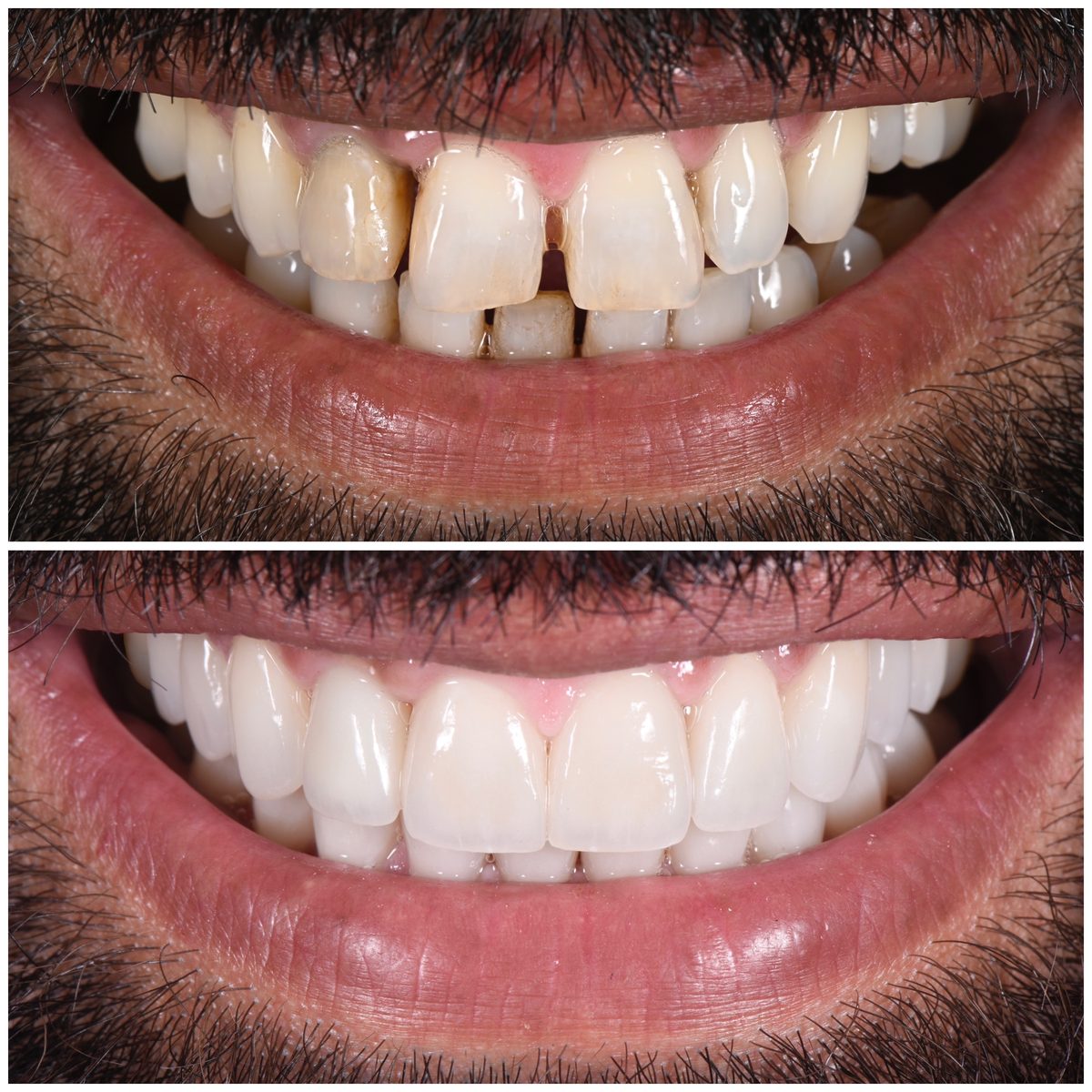 Rezultat fațete dentare - reabilitare estetică totală